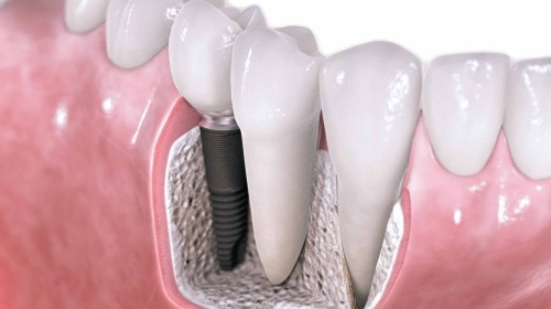 Kiedy podjąć decyzję o wstawieniu implantu?
