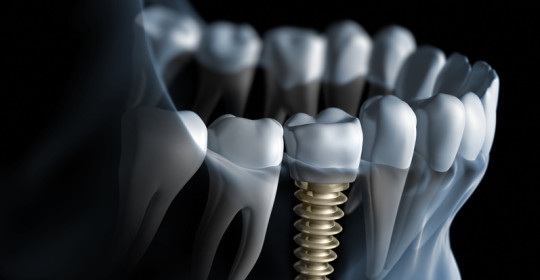 Implanty stomatologiczne w technologii 3D