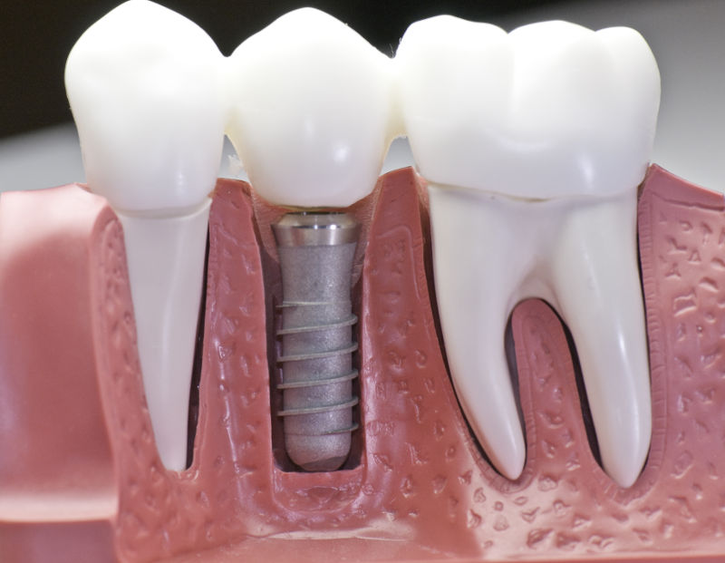 Nowoczesne implanty zębowe z tytanu i ich zalety